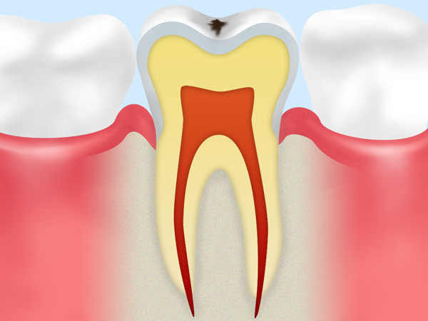 【C0】ごく初期の虫歯