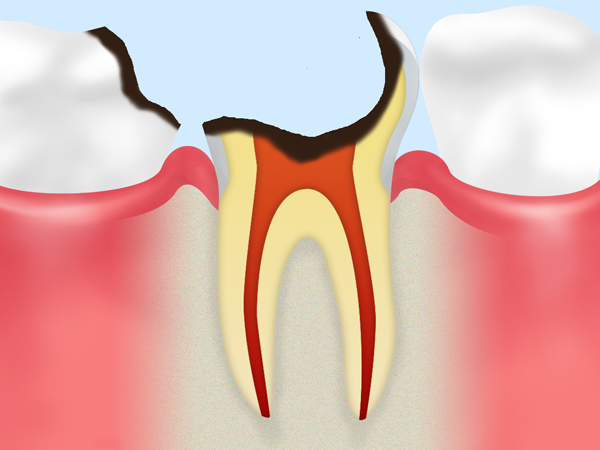 【C4】歯根に達した虫歯