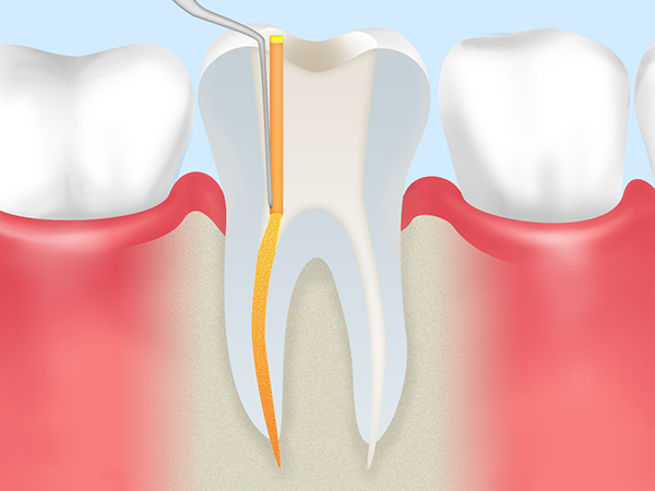進行した虫歯でも、歯を残せるかもしれません～根管治療について～