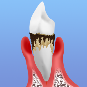 歯周病とは？