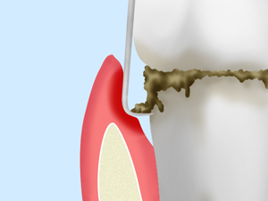 歯周ポケット掻爬（そうは）術